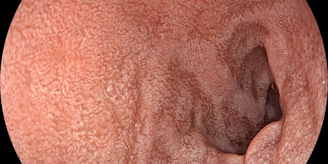 Не перестаю удивляться возможностям и красоте современной эндоскопии