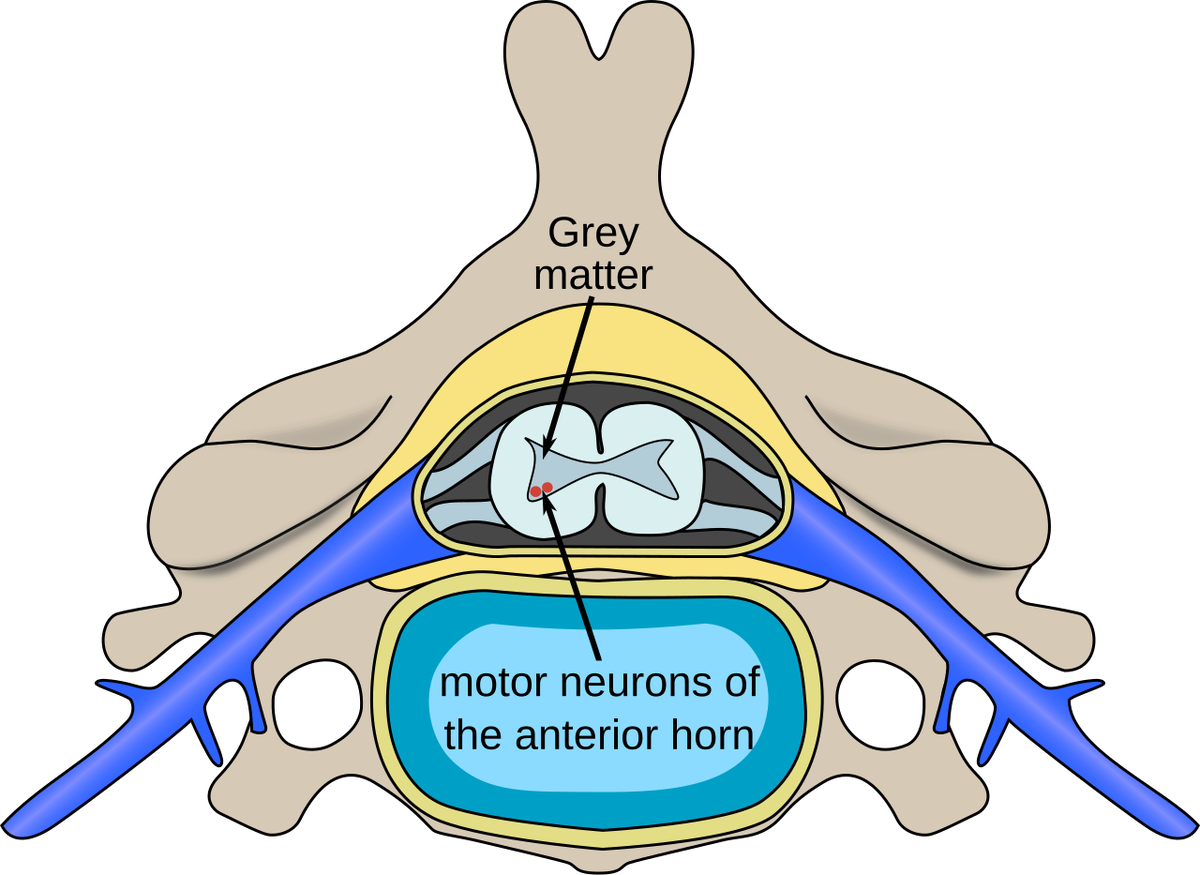    До появления вакцины против полиомиелита основной причиной развития СМА у детей и взрослых была именно эта вирусная инфекция. Полиовирус поражает двигательные нейроны клеток переднего рога, или вентральной (передней) части серого вещества позвоночника, которые контролируют движение мышц туловища и конечностей, включая межреберные мышцы. Сегодня полиомиелит побежден, и корни СМА лежат в генетике.