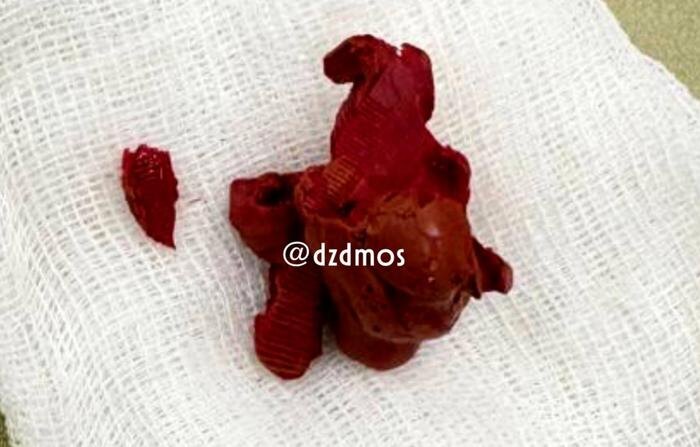 Московские хирурги достали из мочевого пузыря подростка комок пластилина. Фото © Telegram / Московская медицина