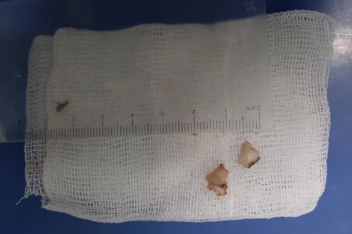    В Липецкой области двухлетний малыш неделю жил с грецкими орехами в бронхах