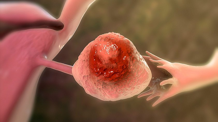 Вот как распространяется рак яичников до того, как врачи смогут его обнаружить