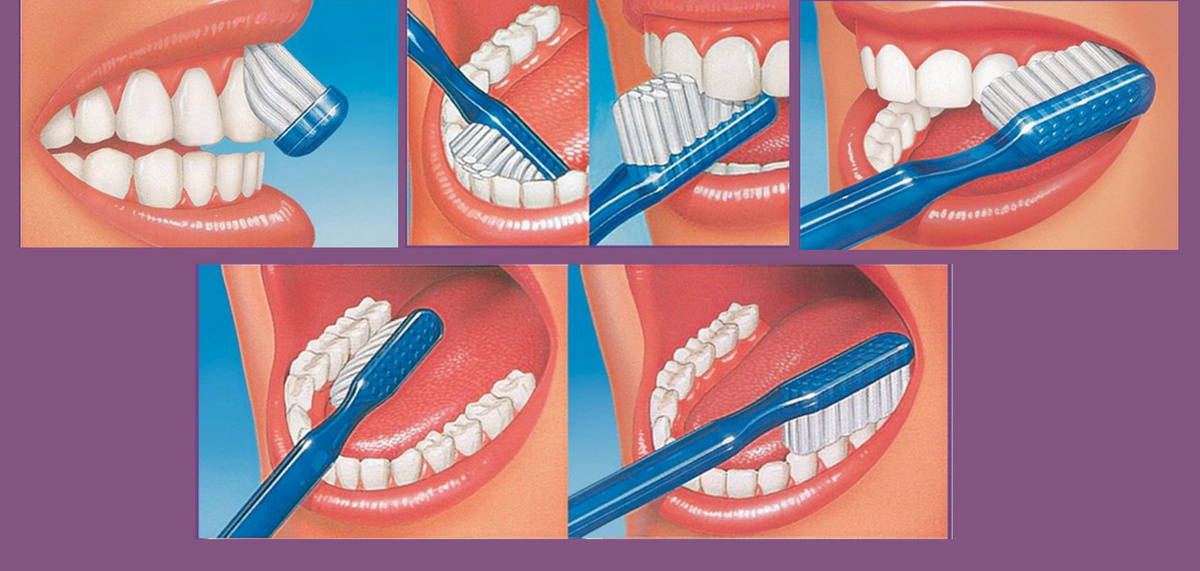 Внешнюю сторону (со стороны щеки) чистят от десны к режущему краю, направляя щетинки под углом 45° к поверхности зуба.
При чистке внутренних поверхностей фронтальной группы зубов удобнее развернуть щётку вертикально.
Одна из техник чистки зубов включает движения от десны к режущему краю с одновременным движением вперёд-назад (вибрация).