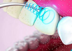 Удаление зубного камня ультразвуковым наконечником.