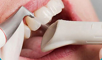 Удаление мягкого налета и пигментов на зубах пескоструйным аппаратом AIR-FLOW