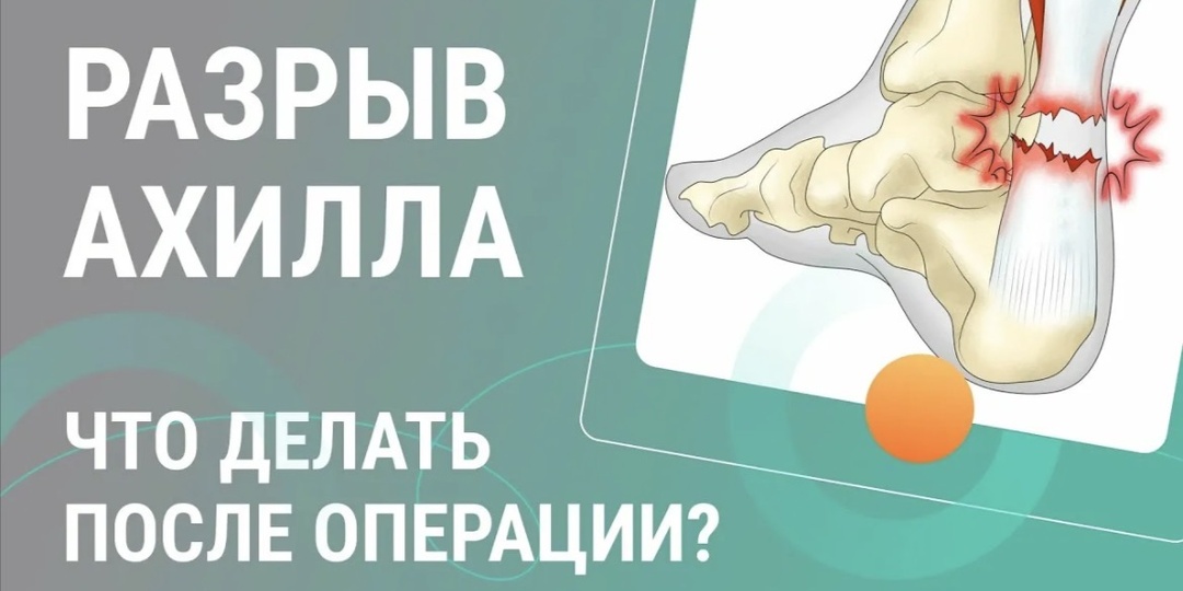 Реабилитация после операции на Ахилловом сухожилии