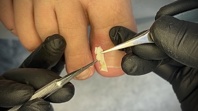 Вросший сегмент боковой стенки