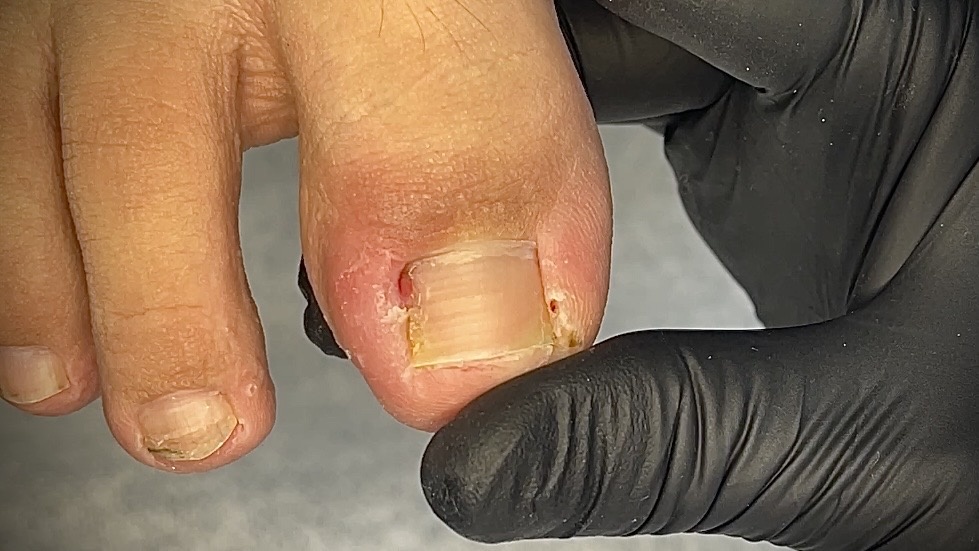 Состояние ногтя на приеме у подолога. Образование грануляции в проксимальной зоне. Признак сложного и глубокого врастания