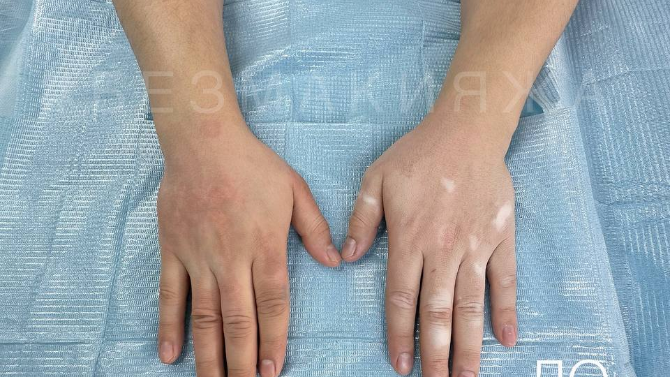 Прячу руки даже летом, помогите