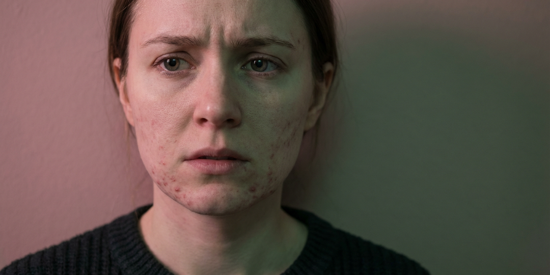 Что такое психосоматика и как кожа реагирует на стресс?