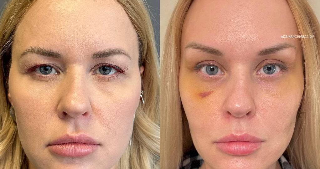 ✨ Пациентка поделилась фотографиями) 11 сутки