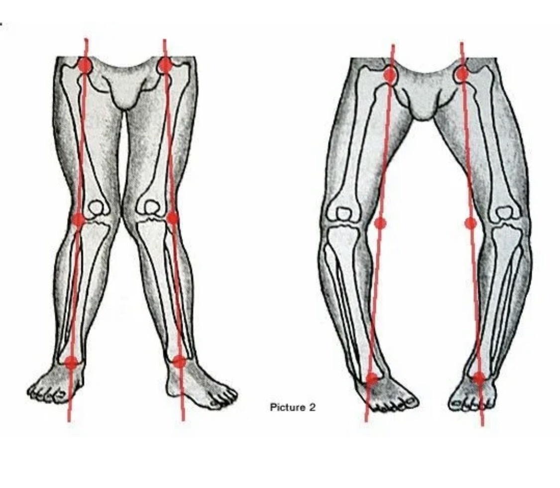 Слева - вальгус, справа - варус