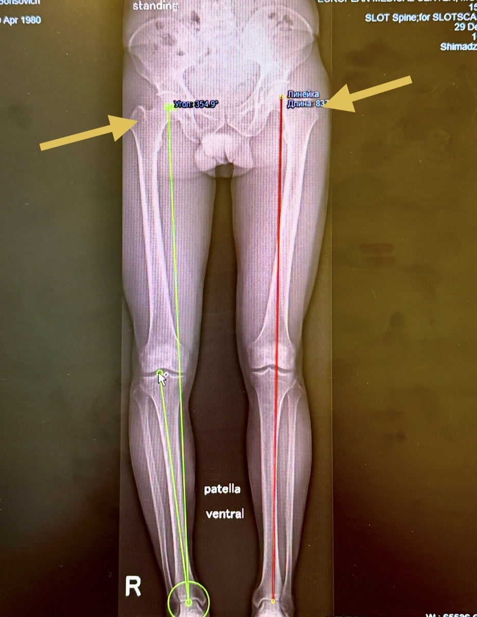 Слева - норма, справа - варус