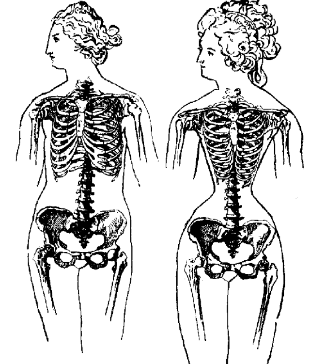 Женщина, имеющая нормальный остов груди (слева), и со скелетом, изуродованным от ношения корсета (справа). (по Г. Плоссу, 1902)