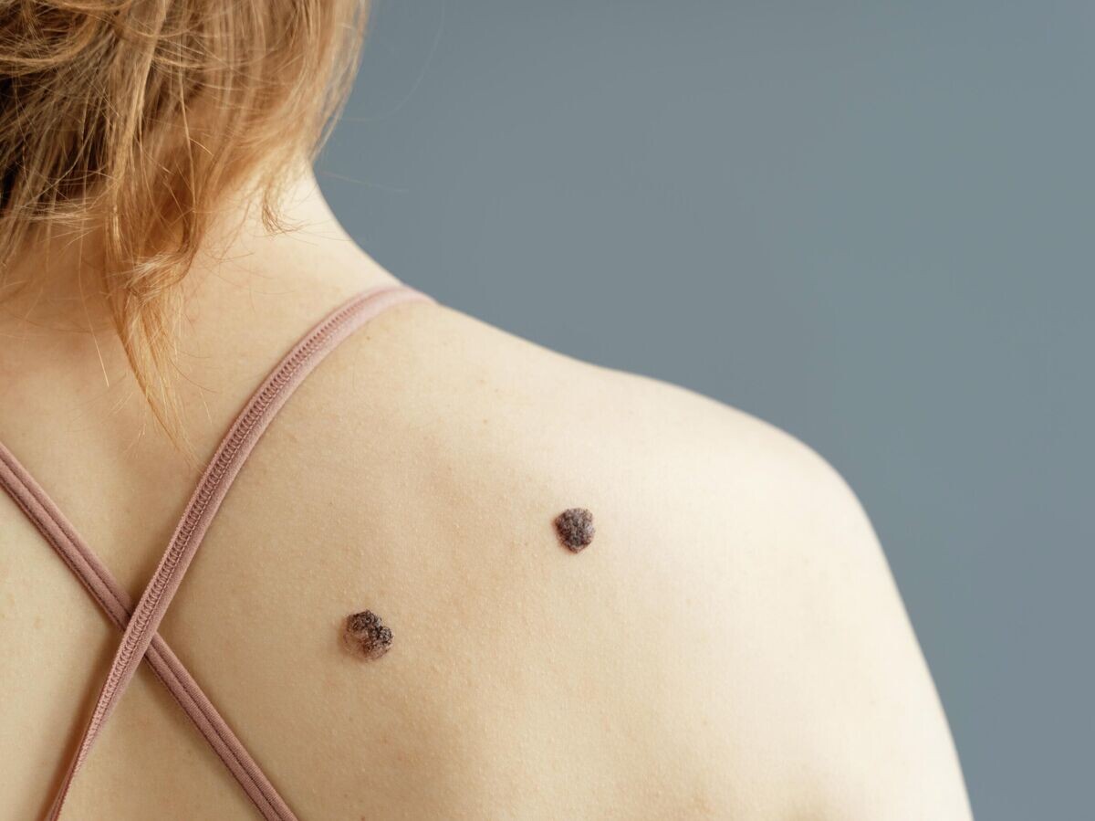    Родинки на спине | © Фото : Freepik