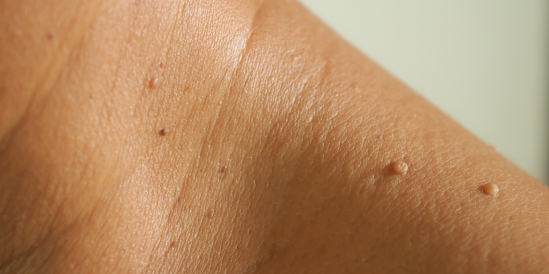 Множественные папилломы после 55 — какие гормональные изменения стоят за этим