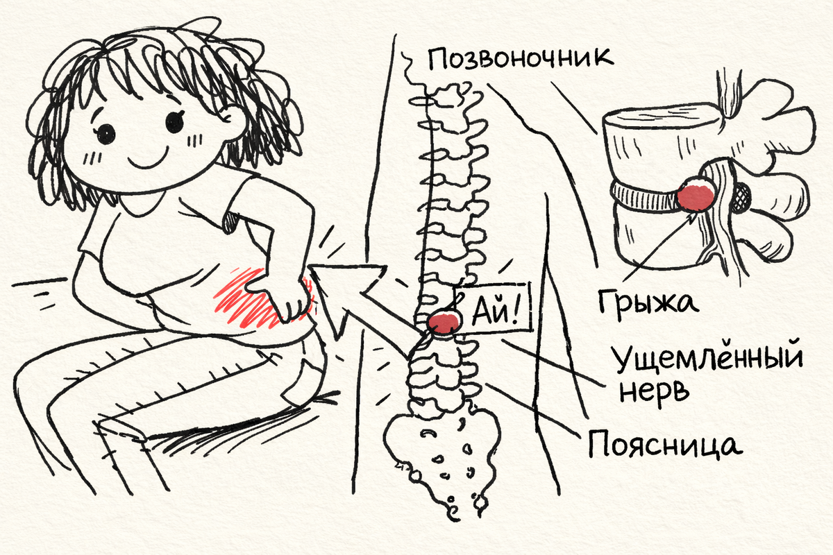#формированиепротрузии