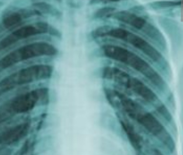 Очаги в лёгких