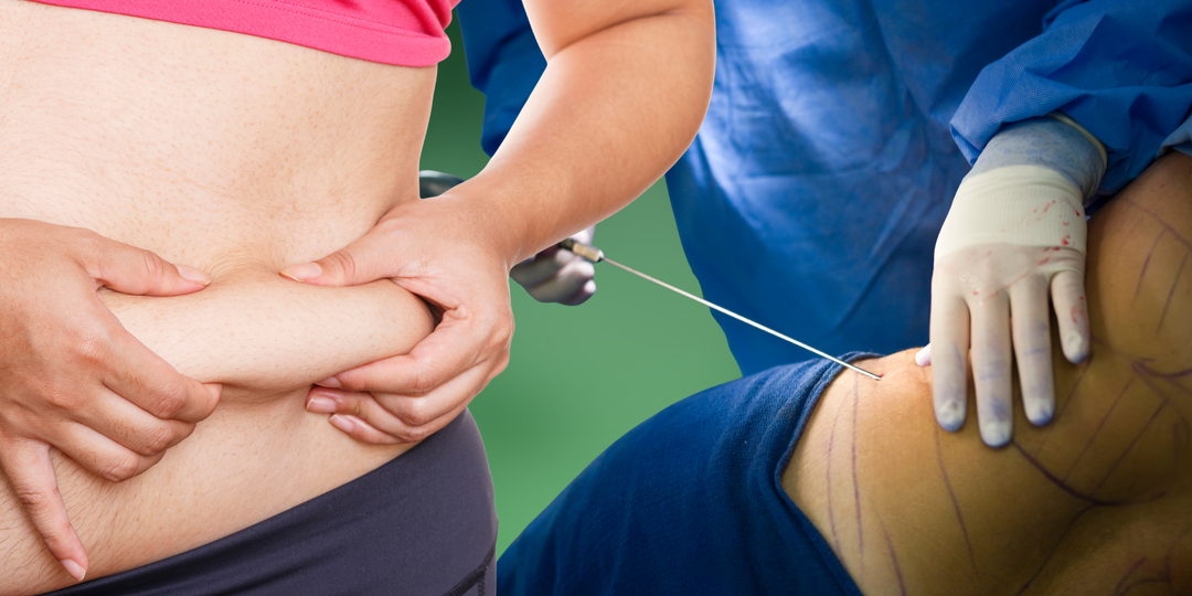 Куда девается жир после липосакции? Хирург рассказывает то, о чем молчат!