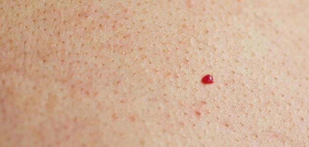 Красная родика - Ангиома