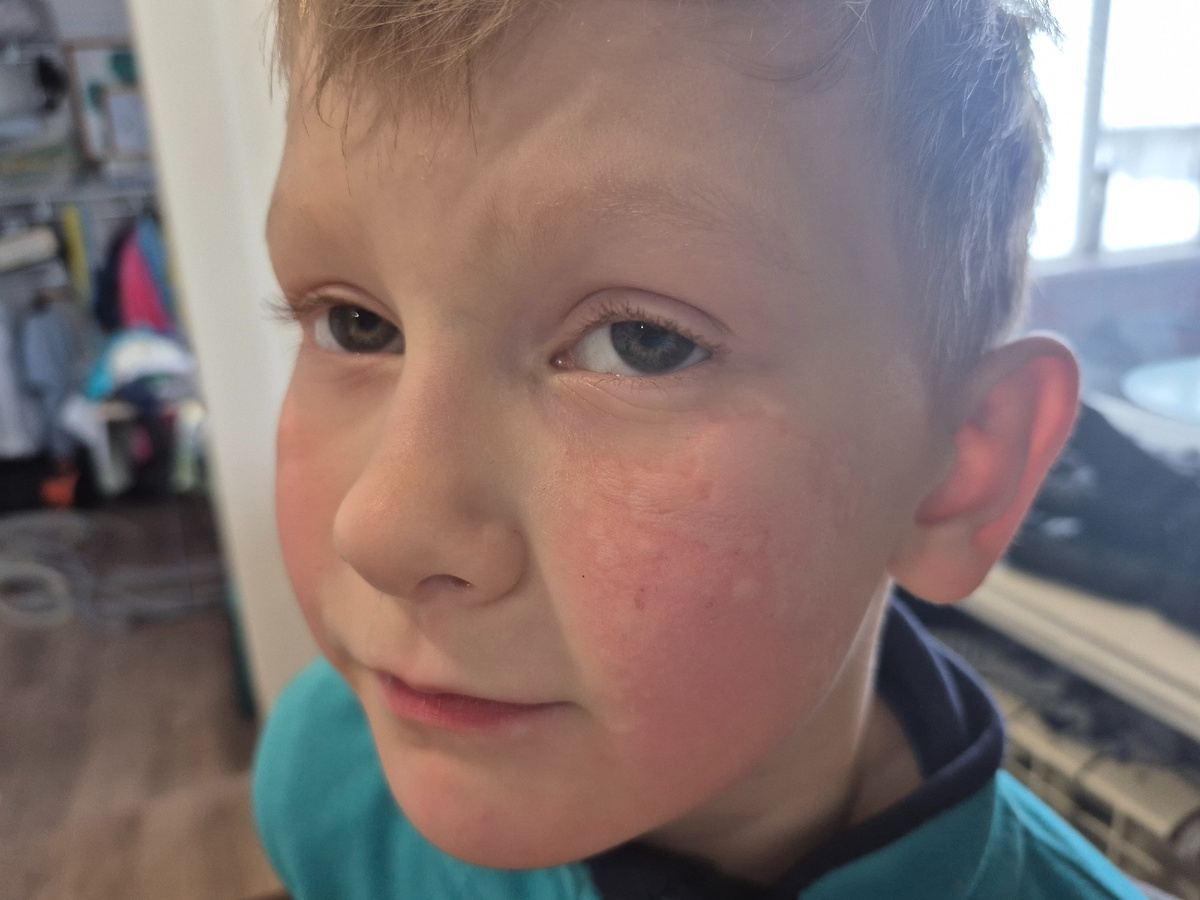 Такого у нас никогда не было. Я бы вообще забила тревогу, но раз такие проявления у всех переболевших, значит виноват вирус... хотя бы понятно, кого винить....