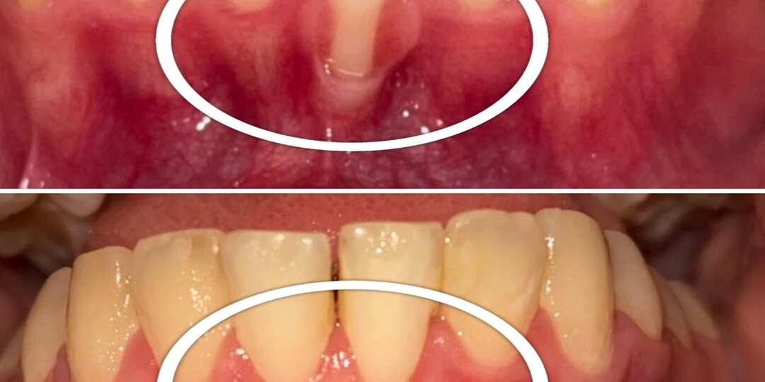 Можно ли остановить рецессию десны без операции