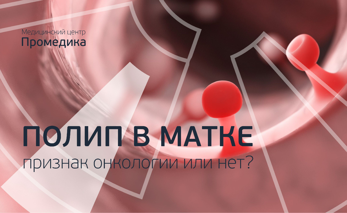 Полип в матке - это онкология или нет? Честный ответ гинеколога-хирурга