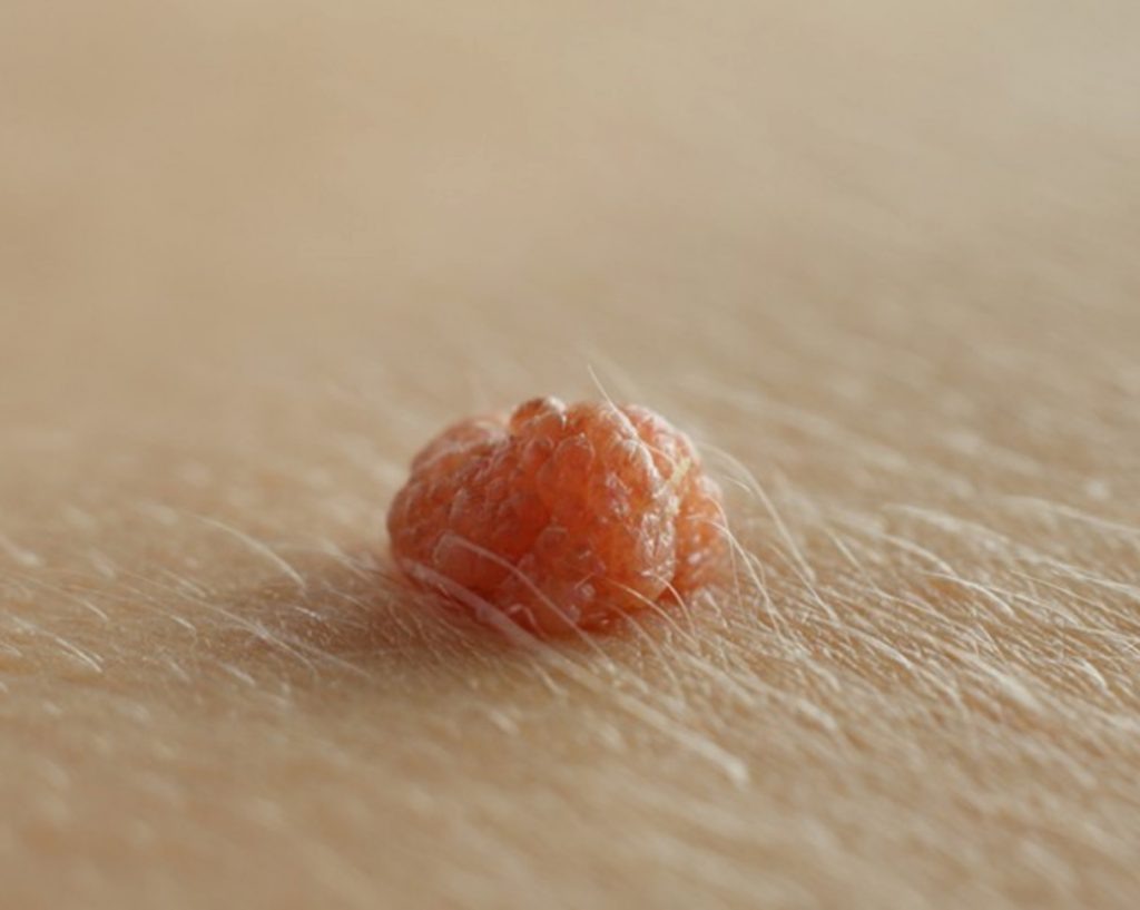 Папиломма. Фото Яндекс Картинки