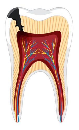 Источник изображения: https://ru.freepik.com/free-vector/human-stages-tooth-decay_24467603.htm#fromView=search&page=1&position=6&uuid=e4bc0a6f-d4ab-4be4-9b92-7197378e598a&query=%D0%BF%D1%83%D0%BB%D1%8C%D0%BF%D0%B8%D1%82