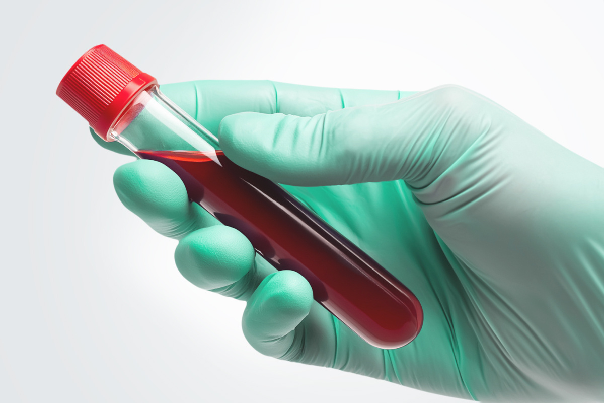 Анализ на определение уровня липопротеина в крови, который говорит о сердечно-сосудистых рисках, стал бесплатным по ОМС в рамках диспансеризации.