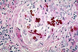 Dermatitidis на добивочку