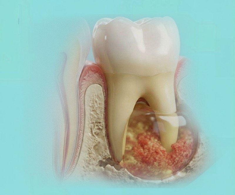 Кистостозное образование корня зуба