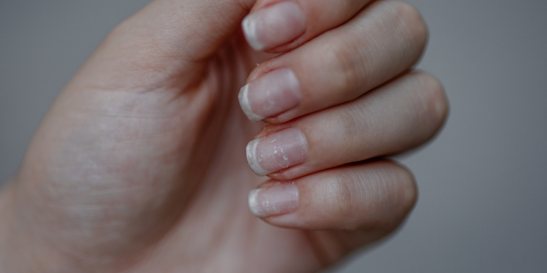 Частые проблемы ногтей и их решение
