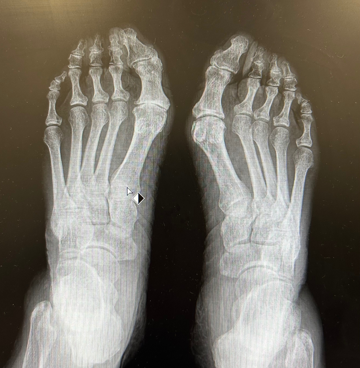 Рентген стопы до операции(хоть на правой ноге деформации выраженней, но на левой ноге явно выражен артроз сустава, который приносит боль)