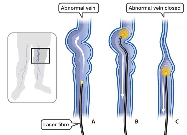 Принцип работы лазерного световода внутри вены. "Запаивание" варикозной вены.