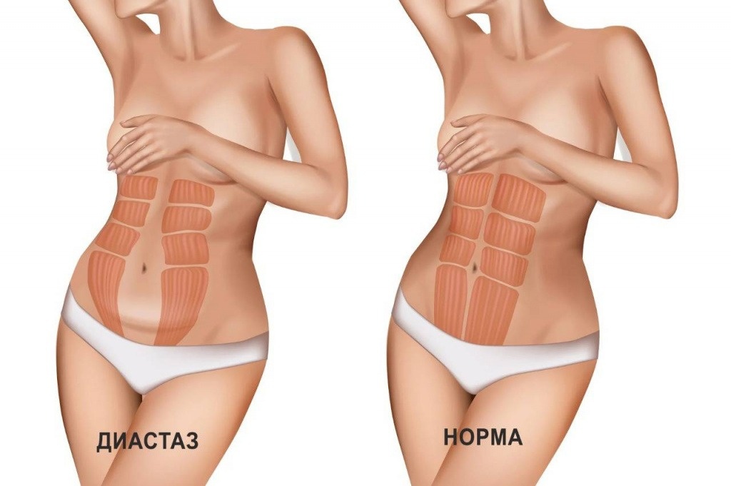 Диастаз прямых мышц живота после родов. источник: https://bryansk.s-classclinic.com/napravleniya/khirurgiya/diastaz-pryamykh-myshts-zhivota/