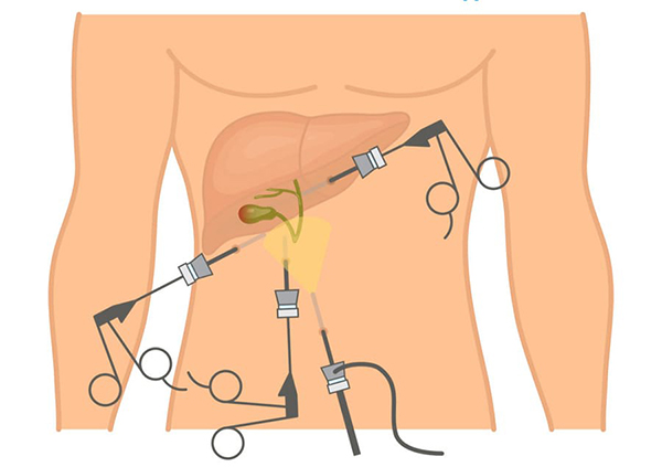 Что происходит после удаления желчного?