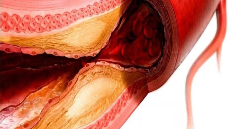 Продукты которые убирают бляшки и холестерин из сосудов!?