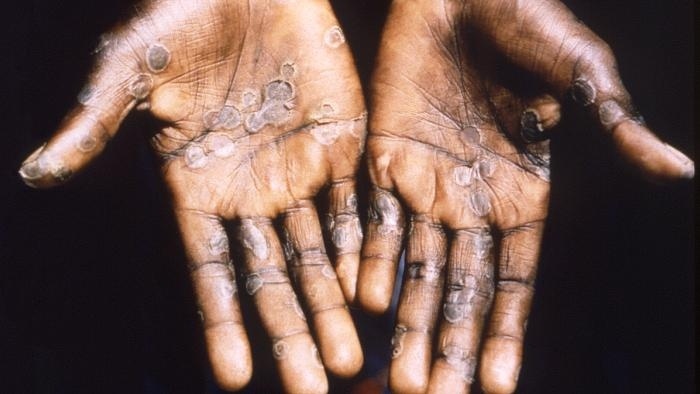     Оспа обезьян   
(cc) CDC. Brian W.J. Mahy