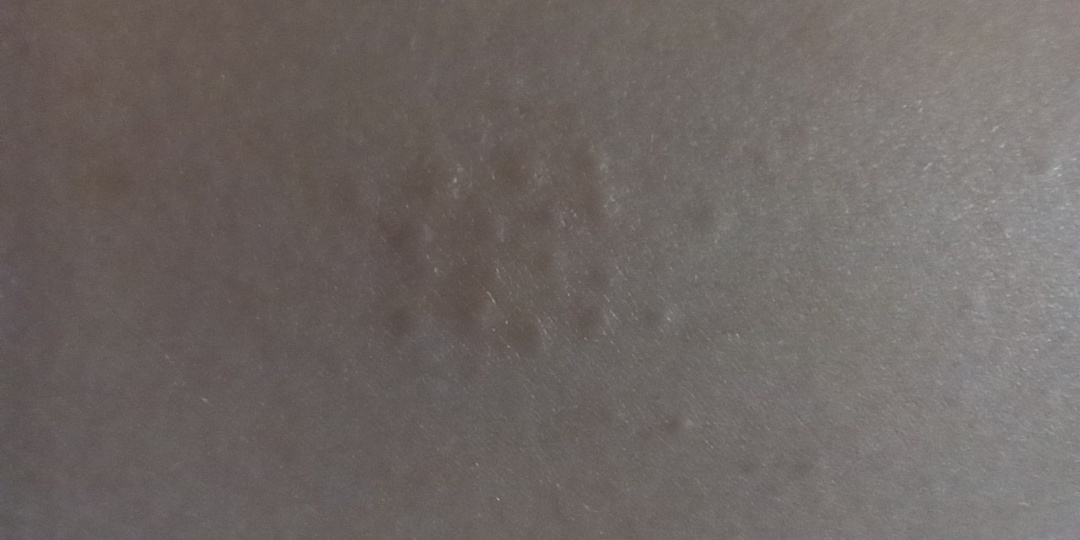 Эти симптомы на коже часто опаснее, чем кажутся