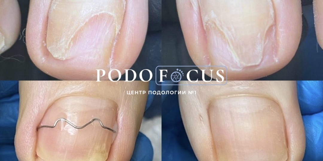 Почему онихолизис возвращается снова и снова?