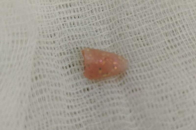    ЧОДКБ. Ноготь