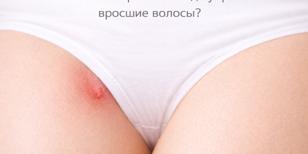 Можно ли лазером навсегда убрать вросшие волосы?