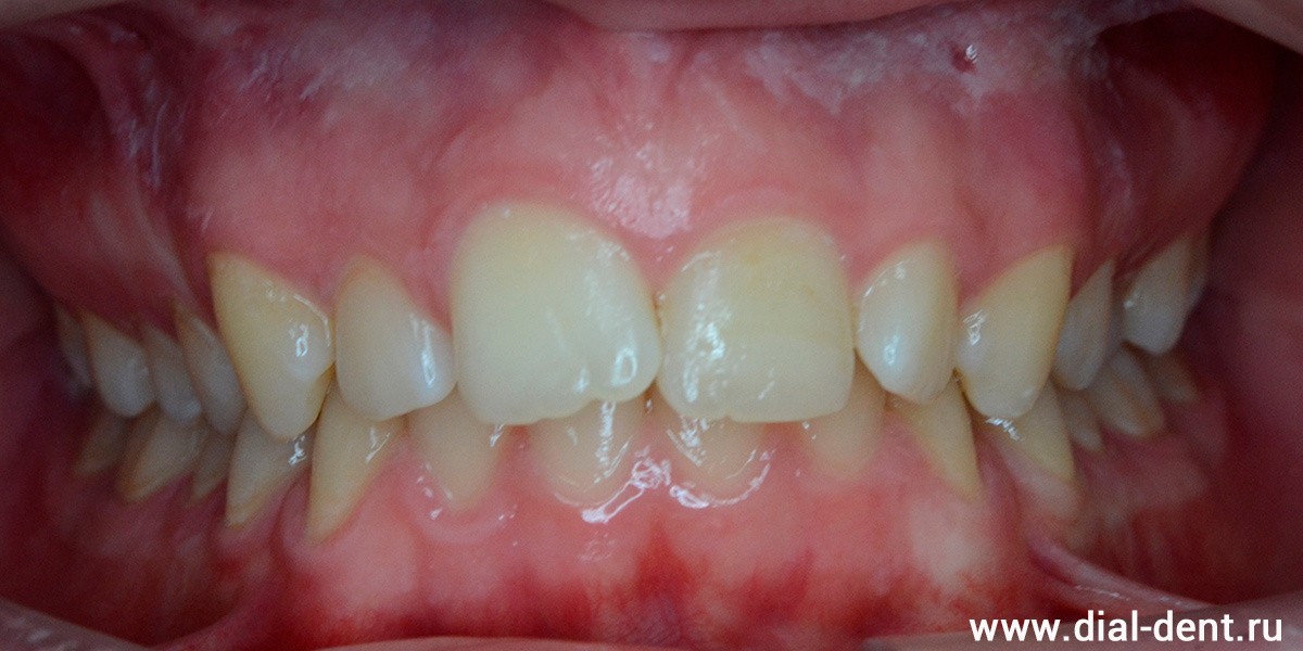 передние зубы растут криво, глубокий прикус