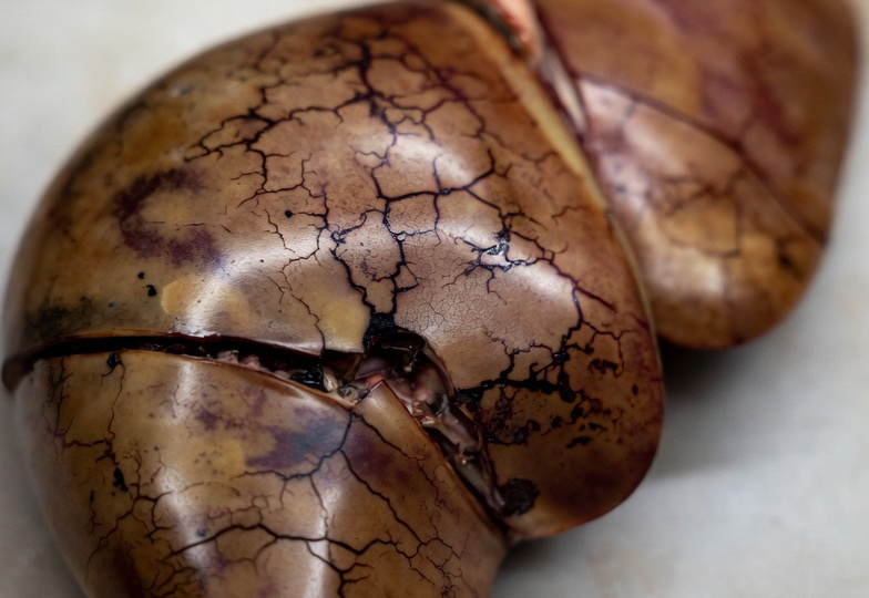 Первые симптомы разрушения клеток печени. Как понять по организму что печень начала разрушаться?