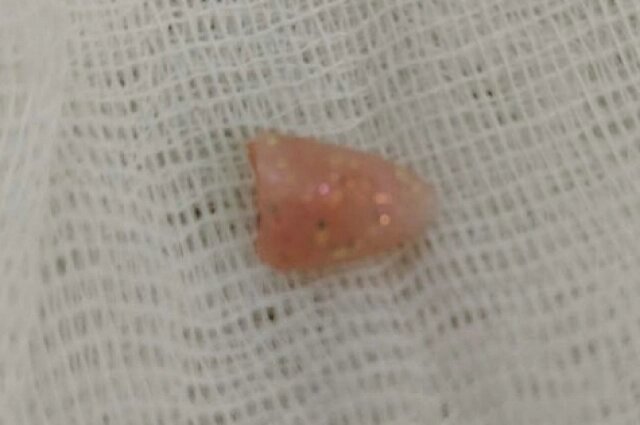    Кусок наращённого ногтя, который достали из горла малыша. Фото: ЧОДКБ