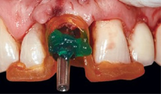 Рис. 2 Положение трансферного ключа, трансферный набор со светоотверждаемой малоусадочной смолой в имплантате с немедленной нагрузкой