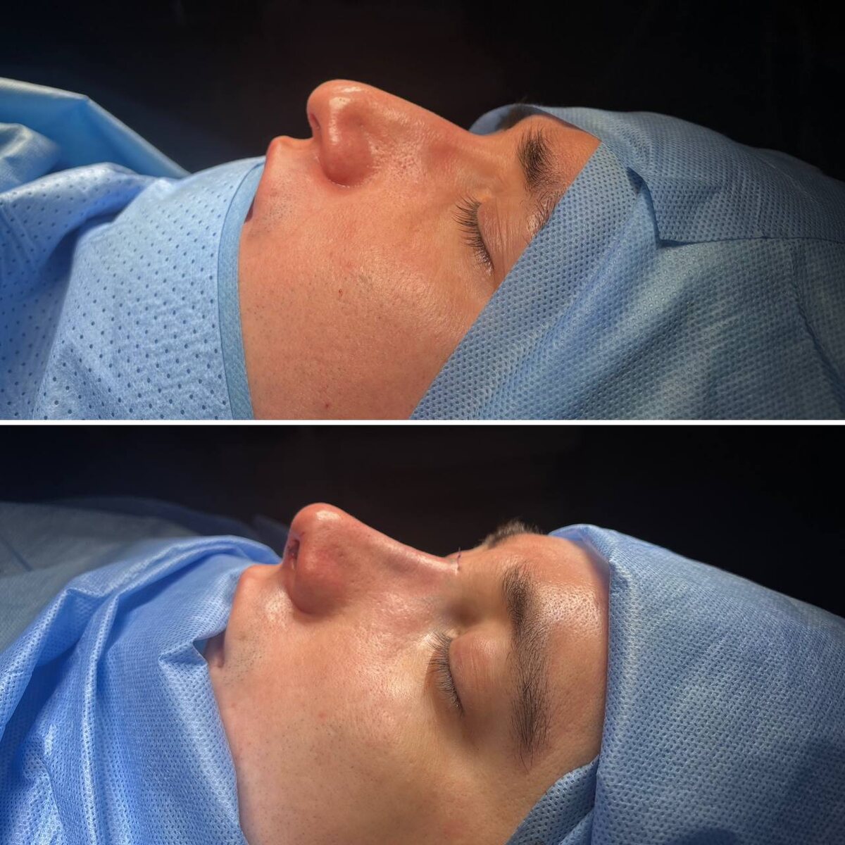 Пластика носа: до сверху, сразу после операции снизу. Хирург Остринская Т. В.
