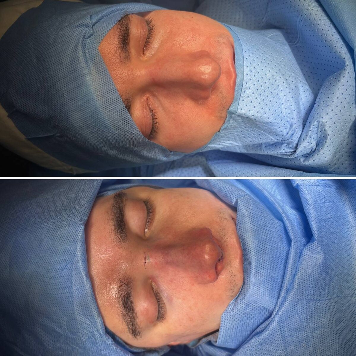 Пластика носа: до сверху, сразу после операции снизу. Хирург Остринская Т. В.