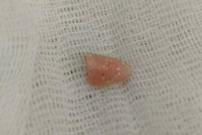 Тот самый ноготь. Фото © VK / ЧОДКБ