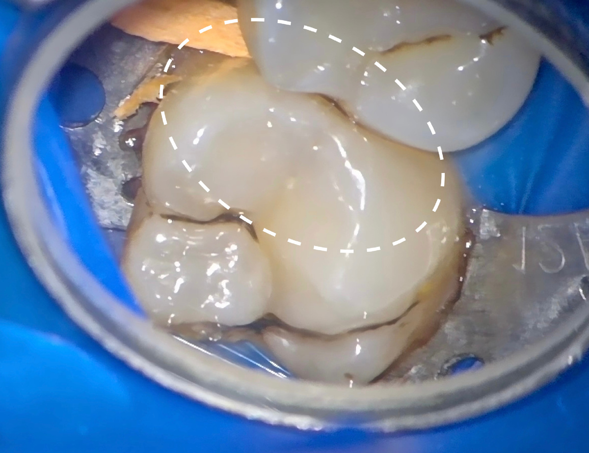 Зуб 7 до лечения